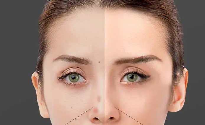 点完痣后留下红印和坑怎么办 点痣 点痣修复 美妆 第2张