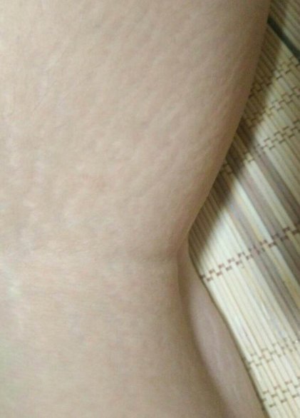 皮肤撑开长纹怎么消除 祛纹 皮肤撑开长纹 美妆 第1张