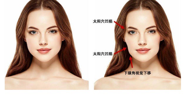脸颧沟怎么消除 脸颧沟 脸颧沟消除 美妆 第1张