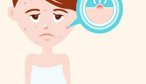 痘痘肌用什么护肤品对皮肤好 痘痘肌 痘痘肌护肤品 美妆 第1张