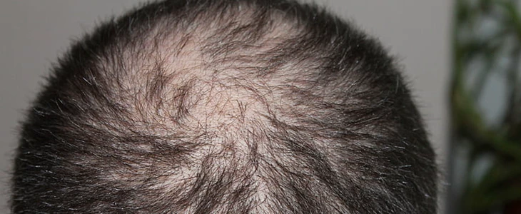 后脑勺出汗是怎么回事 后脑勺 出汗 美妆 第1张