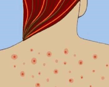 去除鸡皮肤的小知识教你轻松祛除鸡皮肤 鸡皮肤 美白祛黄 第1张