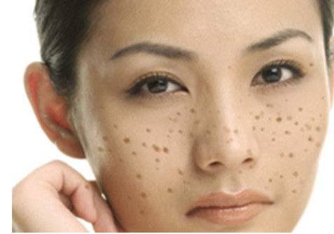 祛斑晒斑黄褐斑怎么办 晒斑 黄褐斑 美妆 第1张