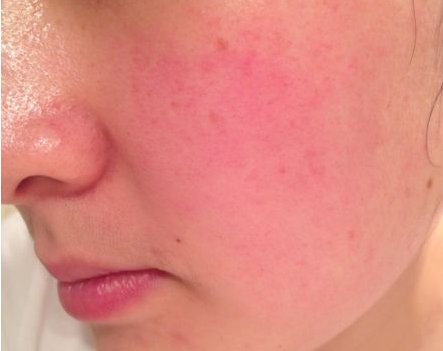 敷面膜后脸红发烫是怎么了 过敏 敷面膜脸红 美妆 第1张 敷面膜后脸红发烫是怎么了 过敏 敷面膜脸红 美妆 第1张