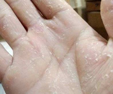 手干裂起皮怎么办 起皮 手干裂起皮 美妆 第1张