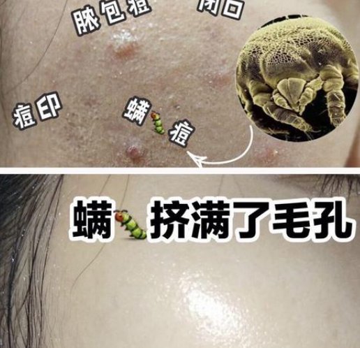 脸上螨虫坑怎么清理 螨虫坑 清除螨虫 美妆 第1张