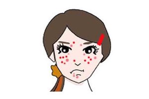 维胺酯维e乳膏能去痘痘吗