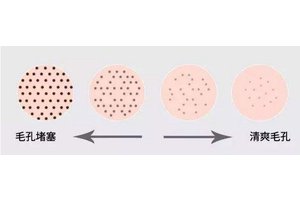 草莓鼻子怎么去掉还能缩小毛孔