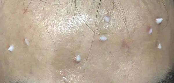 理肤泉青春痘调理精华乳怎么样，理肤泉青春痘调理精华乳使用测评 精华 理肤泉 第6张