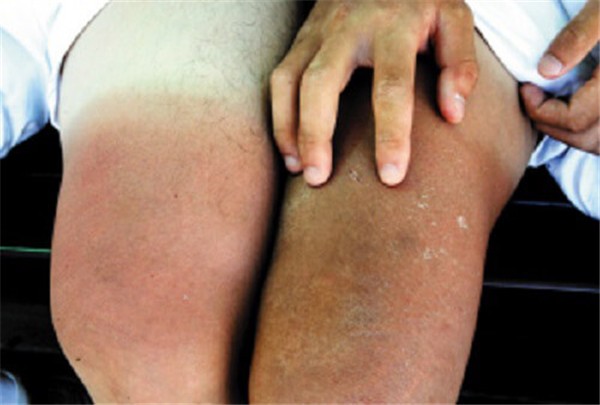 皮肤晒伤了怎么办，皮肤晒伤了怎么修复 护肤 第1张