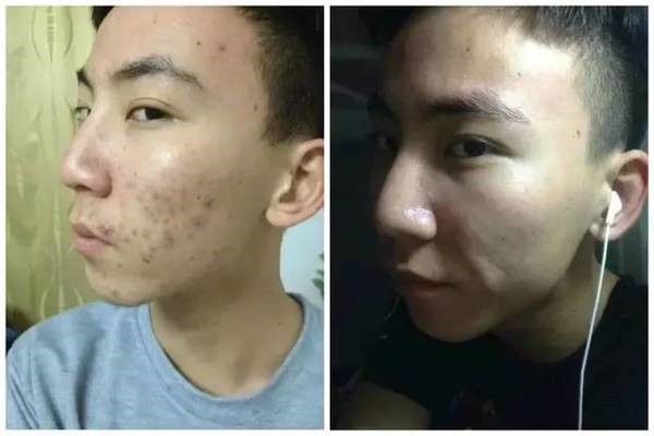 适合学生的祛痘方法，几个方法帮你告别痘痘 痘痘 第1张