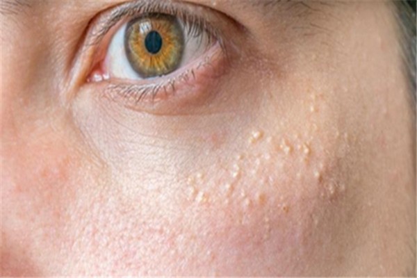 巧妙去除闭口粉刺的方法：选择适合自己肤质的化妆品 闭口 粉刺 第1张