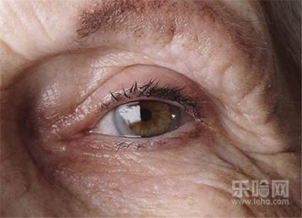 眼角纹多是什么原因 护肤 第1张