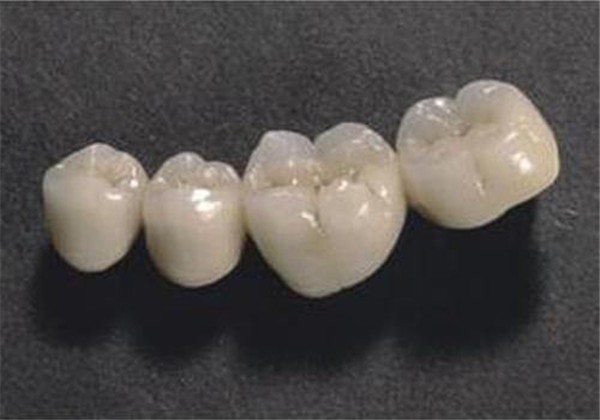 烤瓷牙可以取下来吗 护肤 第1张 烤瓷牙可以取下来吗 护肤 第1张