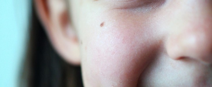 怎么去脸上的红血丝 红血丝 美妆 第3张