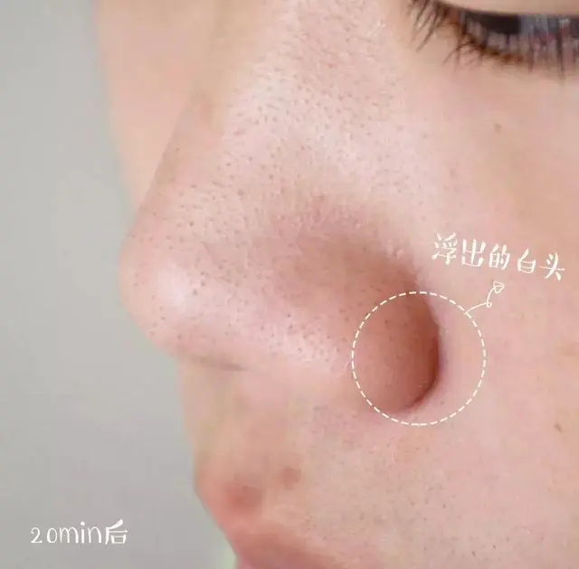 值得回购的清洁面膜有哪些 黑头 清洁 清洁面膜 美容 第8张