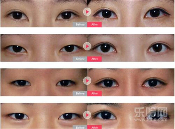 开内眼角会留疤吗 护肤 第4张