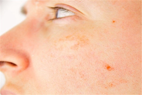 有哪些有效的祛斑方法，户外活动要注意防晒 祛斑 防晒 第1张