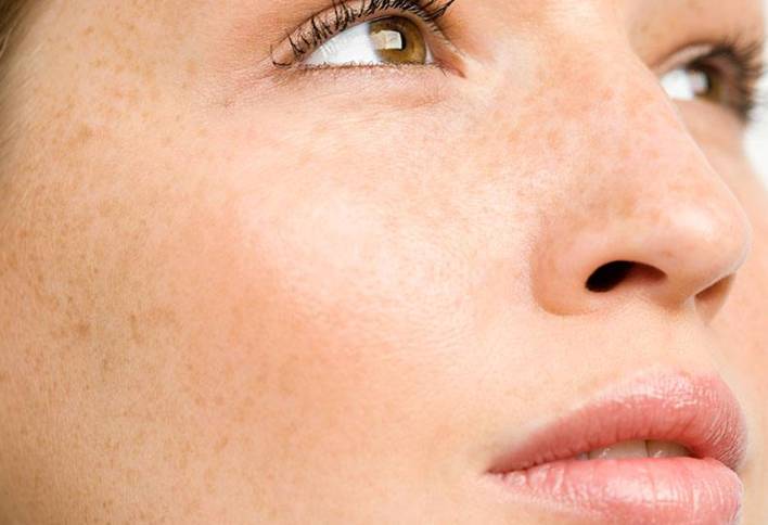脸部点斑怎么办 祛斑 脸部点斑 美妆 第1张