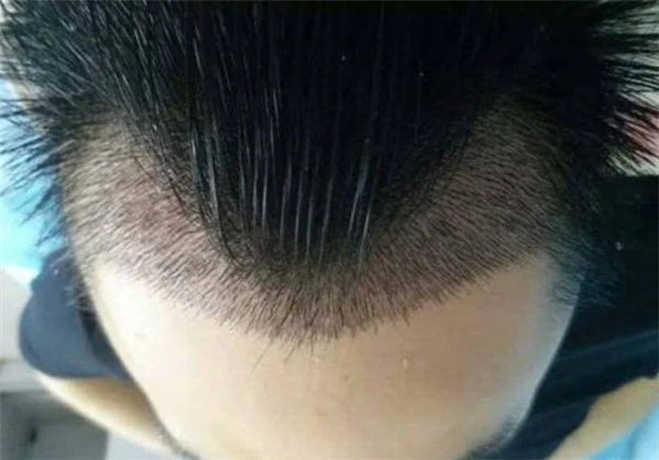 m字型发际线怎么办 发际线 m字型发际线 美妆 第2张