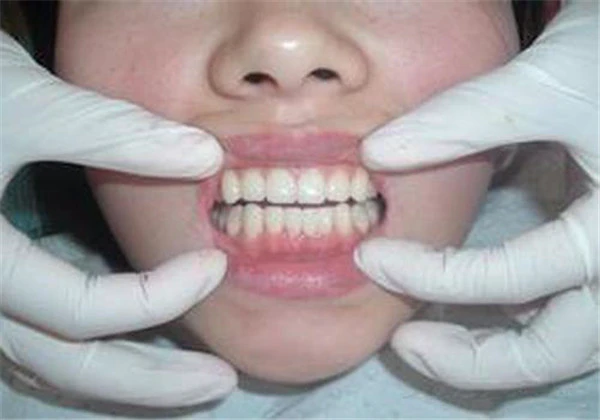 烤瓷牙怎么取下来 护肤 第3张 烤瓷牙怎么取下来 护肤 第3张