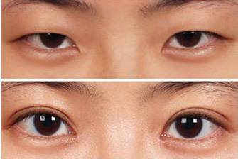 谁做过单眼皮还原 单眼皮 双眼皮 美妆 第1张 谁做过单眼皮还原 单眼皮 双眼皮 美妆 第1张