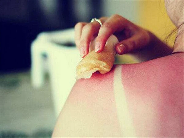 皮肤晒伤了怎么办，皮肤晒伤了怎么修复 护肤 第2张