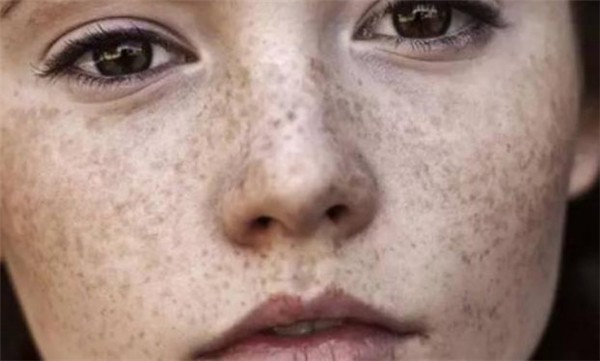祛完斑应该注意什么 祛斑 祛斑注意事项 美妆 第1张