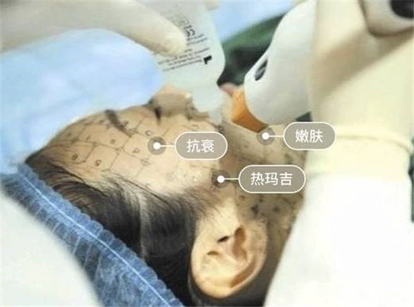 热玛吉的原理和功效维持多久 热玛吉 热玛吉功效 美妆 第2张