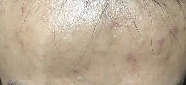 理肤泉青春痘调理精华乳怎么样，理肤泉青春痘调理精华乳使用测评 精华 理肤泉 第7张