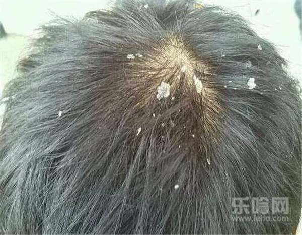 怎么去头屑又快又好 护肤 第4张