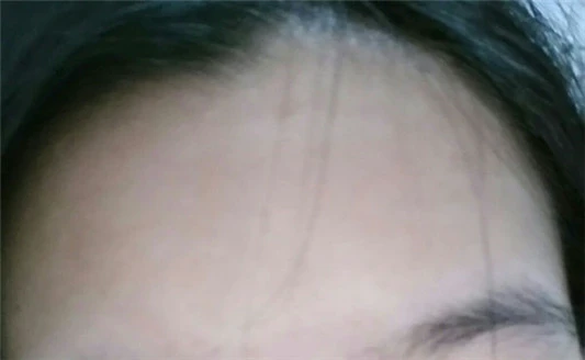 比度克祛痘膏祛痘怎么样,比度克祛痘膏使用测评 比度克 祛痘膏 第5张 比度克祛痘膏祛痘怎么样,比度克祛痘膏使用测评 比度克 祛痘膏 第5张