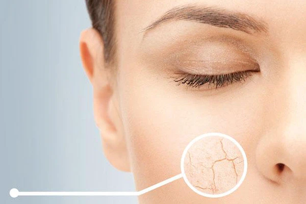 脸上皮肤干燥，起皮应该怎么办 面霜 第3张