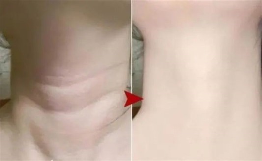 出现颈纹怎么办，用这四个诀窍击退，重塑美丽天鹅颈 颈纹 第1张