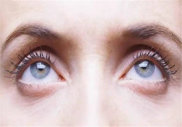 下眼袋可以去掉吗，只要发现的早，去除下眼袋就不是梦想！ 护肤 第2张