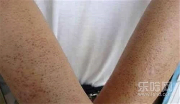 磨砂膏能去鸡皮肤吗 护肤 第2张