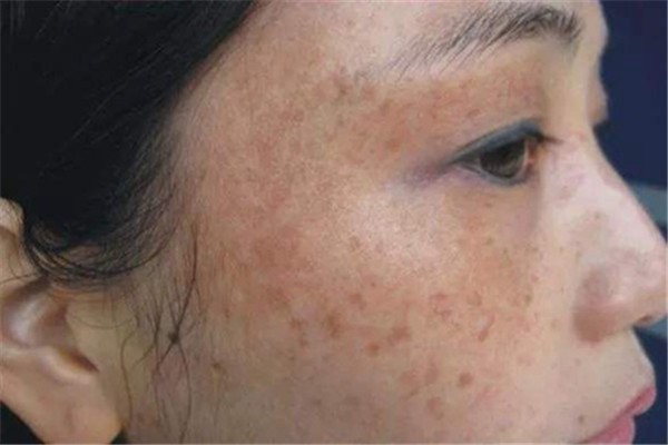 淡化脸上斑的正确方法：洁面彻底清除面部垃圾 淡化 斑 第1张