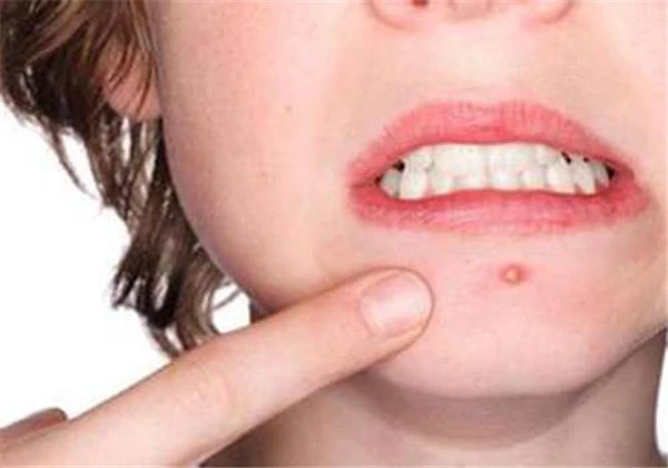 夏季长痘的原因，6大原因让你夏天一直长痘 护肤 第6张