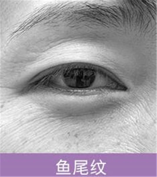 鱼尾纹和笑纹一样吗,笑纹和鱼尾纹区别 笑纹 鱼尾纹 笑纹和鱼尾纹有什么区别 美容 第2张 鱼尾纹和笑纹一样吗,笑纹和鱼尾纹区别 笑纹 鱼尾纹 笑纹和鱼尾纹有什么区别 美容 第2张