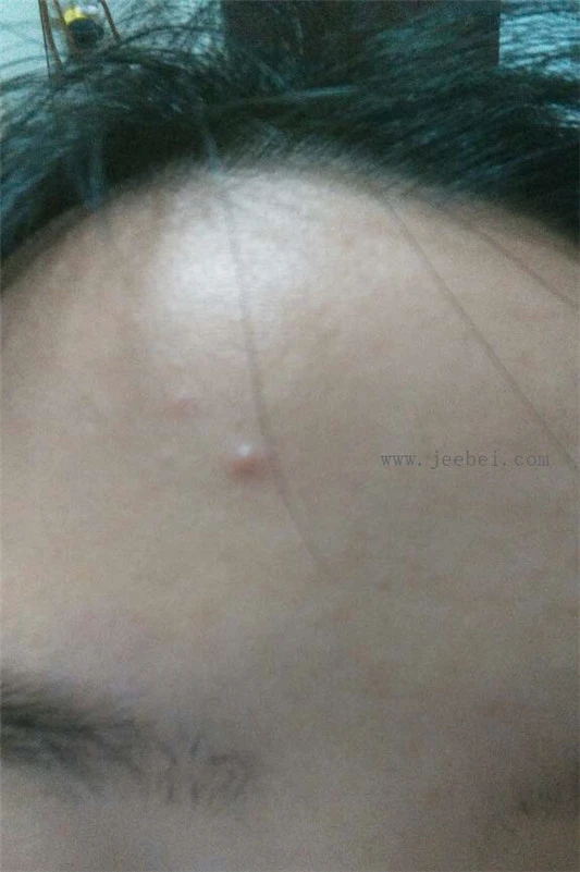 比度克祛痘膏祛痘怎么样,比度克祛痘膏使用测评 比度克 祛痘膏 第4张 比度克祛痘膏祛痘怎么样,比度克祛痘膏使用测评 比度克 祛痘膏 第4张