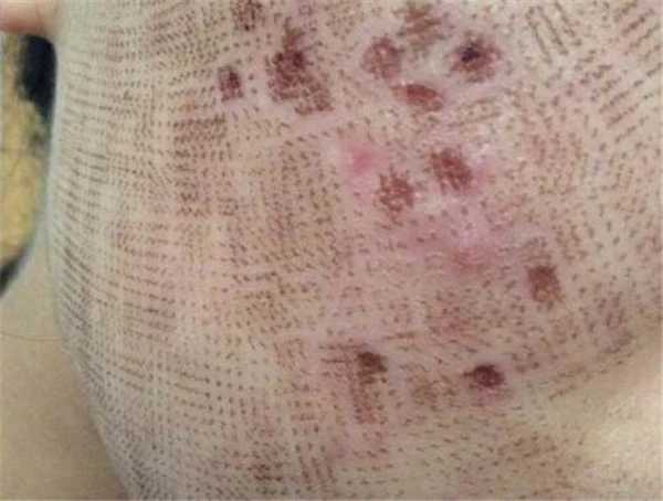 点阵激光后多久恢复正常肤色 护肤 第5张