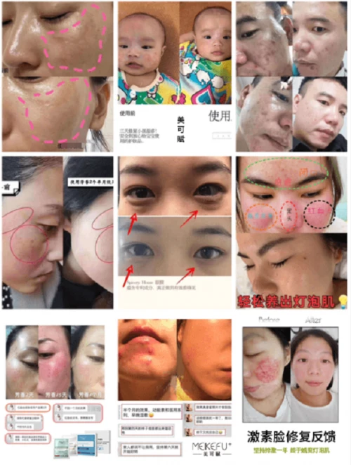 医美亚洲之星美可赋医用皮肤级面膜，酵母重组胶原蛋白敷贴 面膜 医用皮肤级面膜 护肤 第3张