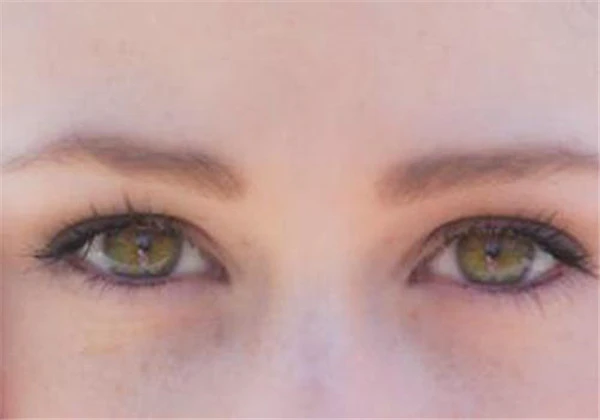 吸脂去眼袋有效果吗，眼袋吸脂有效果吗 护肤 第6张