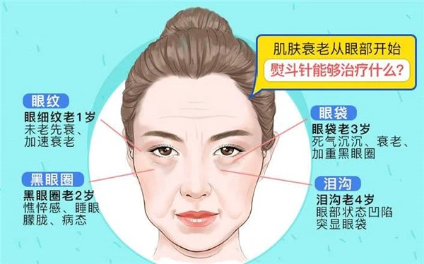 嗨体填充泪沟维持多久 美容 嗨体填充泪沟 美妆 第2张