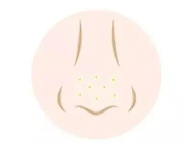 鼻子上挤出的白色东西是什么，三种方法清除他 鼻子 鼻子上挤出的白色东西是什么 美容 第2张