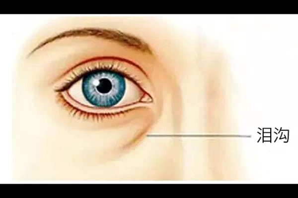 泪沟是怎么来的，泪沟要怎么消除 皮肤 第2张