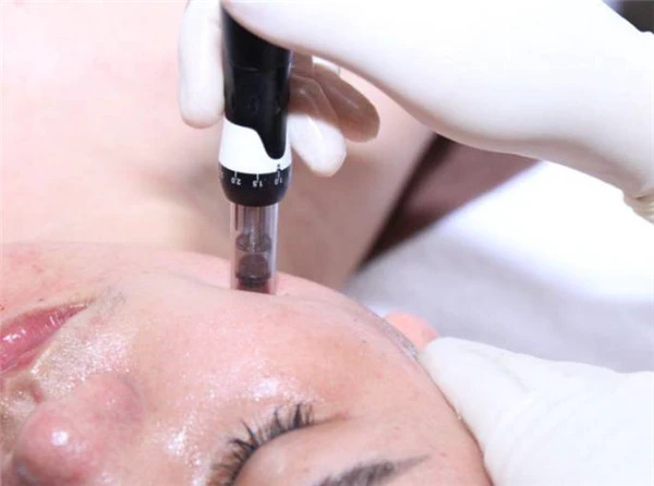 mts微针哪些人不能做 微针 mts微针 美妆 第2张 mts微针哪些人不能做 微针 mts微针 美妆 第2张