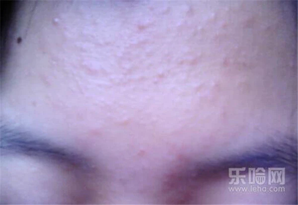 压力大额头长痘怎么办 护肤 第2张