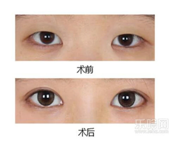 开内眼角会留疤吗 护肤 第3张