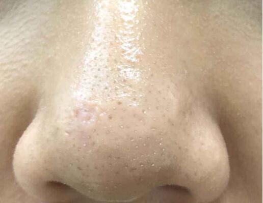 脸上毛孔粗有黑头怎么办 毛孔粗 黑头 美容 第1张